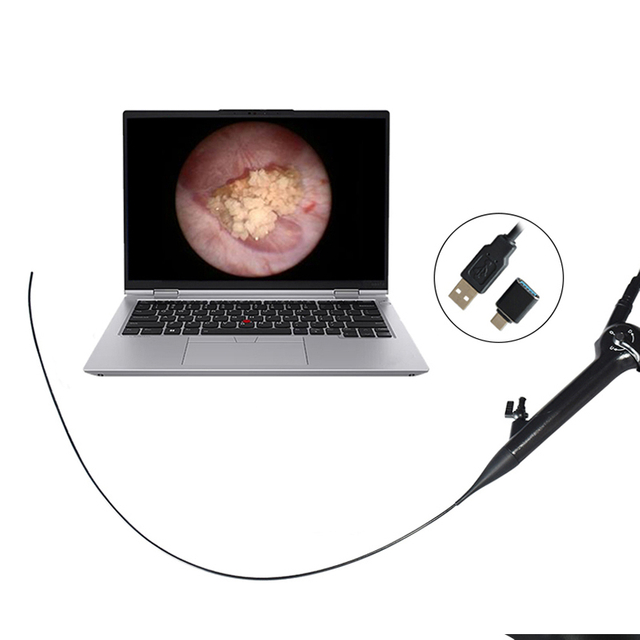 Single Use Minimally Invasive Surgery Flexible Choledochoscope
