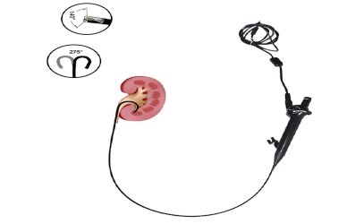 Pediatric Urology Procedures Made Safer with Flexible HD Electric Ureteroscopes