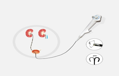 Flexible Ureteroscopes in Early Detection of Urinary System Tumors